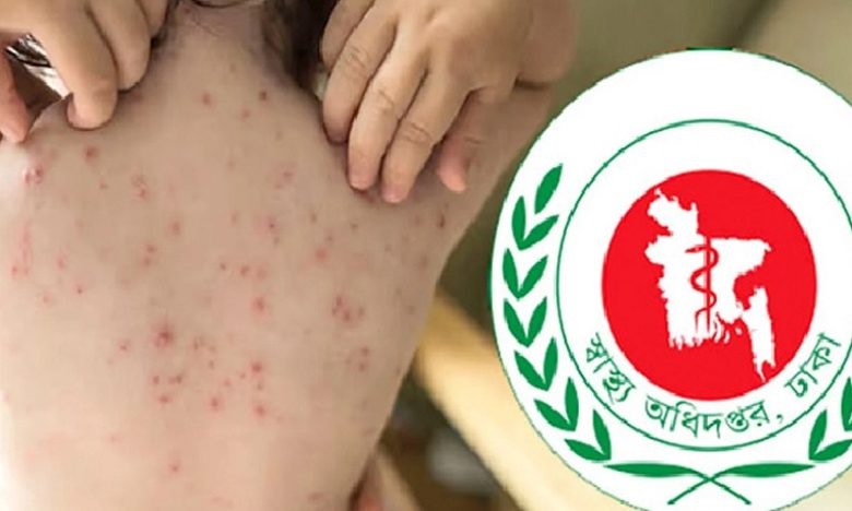 হাম ও উপসর্গ নিয়ে প্রাণ গেল আরও ১৩ শিশুর
