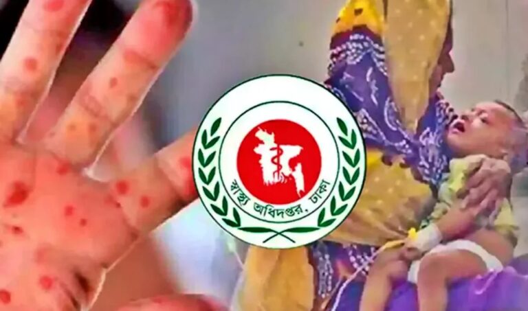হাম উপসর্গে প্রাণ গেল আরো ২ শিশুর, মৃত্যু ছাড়াল ৪৫০
