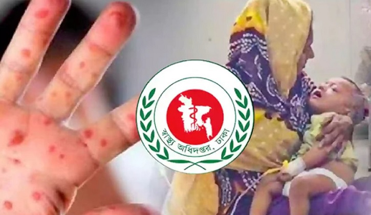 হাম ও উপসর্গ নিয়ে প্রাণ গেল ১২ শিশুর