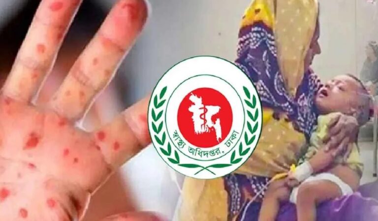 হাম উপসর্গে সিলেটে প্রাণ গেল আরও ৩ শিশুর