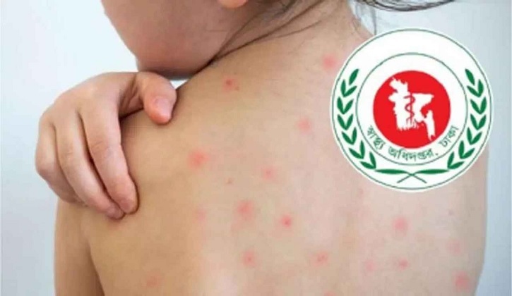 ২৪ ঘণ্টায় হাম উপসর্গে আরও ২ জনের মৃত্যু