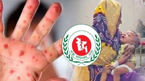 হাম ও উপসর্গে মৃত্যু হাজার ছাড়ালো